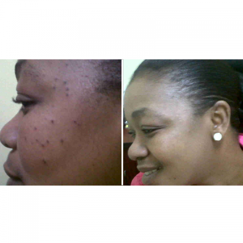 Glutathione Nano Patch before and after photo