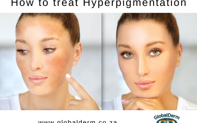 Pigmentation and How To Treat It